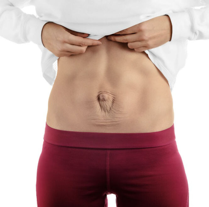 Diástase Abdominal